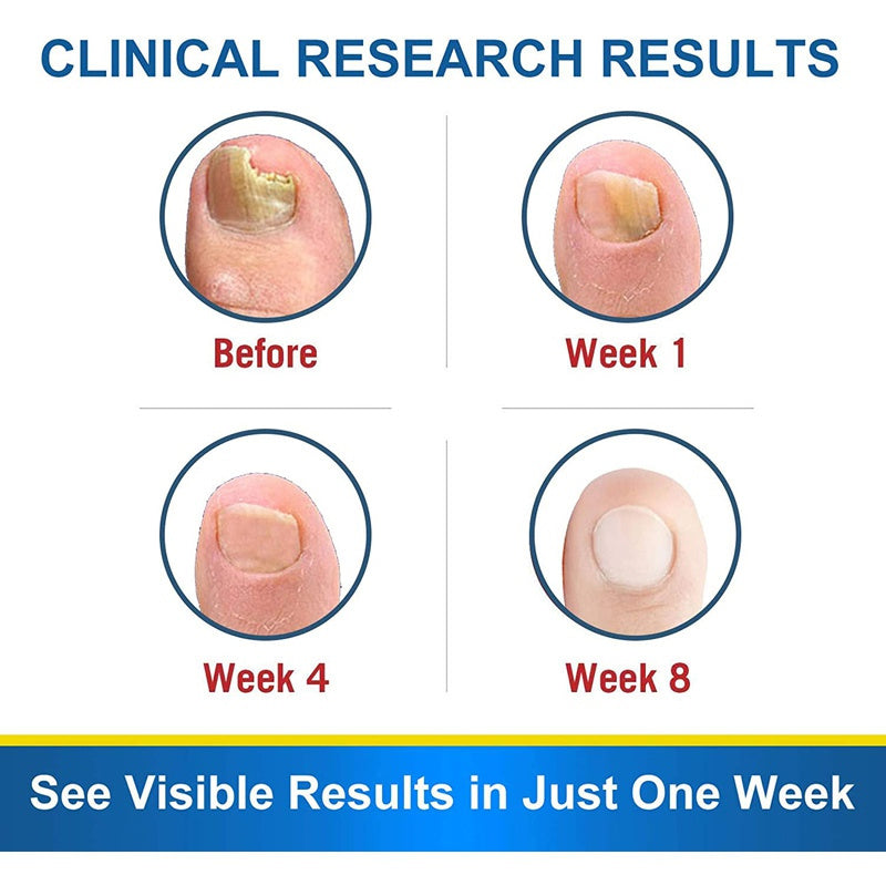 7DAYS Hand And Foot Nail Fungus Removal treatment