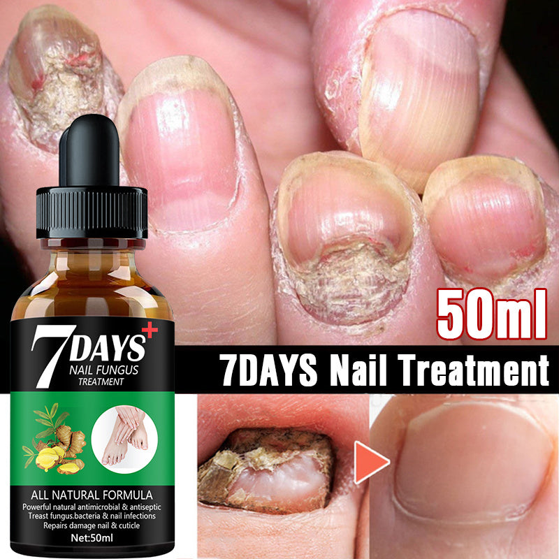 7DAYS Hand And Foot Nail Fungus Removal treatment