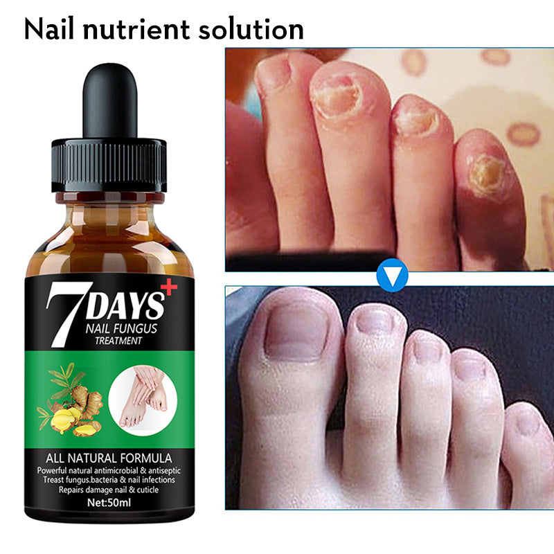7DAYS Hand And Foot Nail Fungus Removal treatment