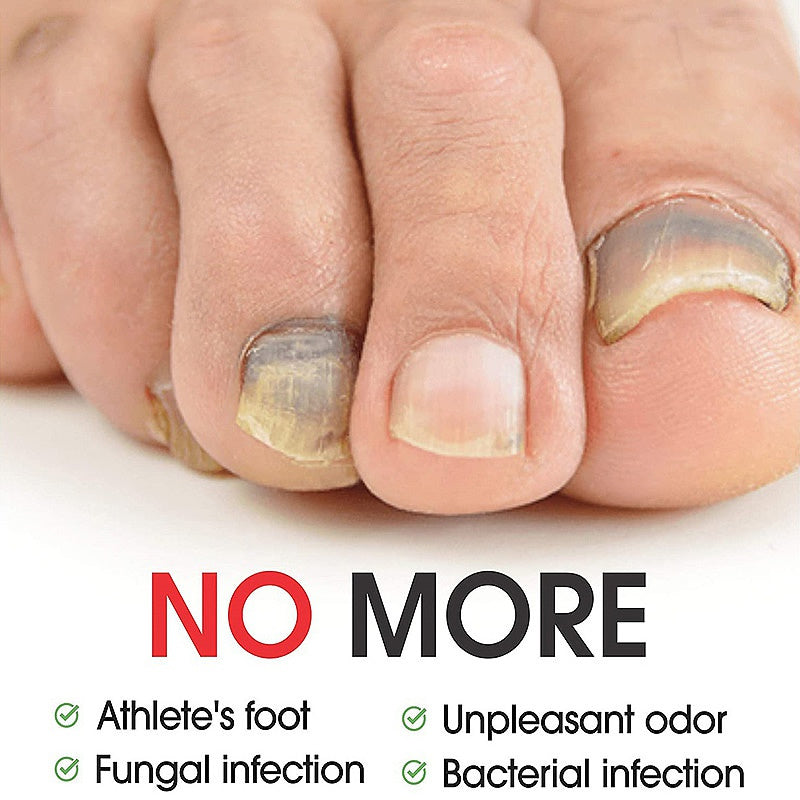 7DAYS Hand And Foot Nail Fungus Removal treatment